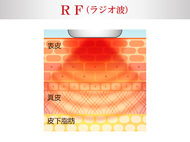 RF(���W�I�g)